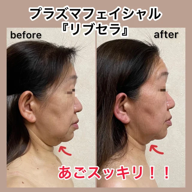 エイジングケアの救世主プラズマフェイシャル『リブセラ』✨

なんと...1回目でこの効果❣️

あご下のたるみがすっきりに😍

たるんだお肌を引き締め引き上げる
ハイフ越えとも言われるリブセラ

プラズマエネルギーの効果がすごい😳♡

さらにヘッド・デコルテのマッサージでお顔周りのリンパも流すことでお顔のむくみもとれ効果アップ✨

プラズマフェイシャル『リブセラ』
ヘッド・デコルテマッサージ付き
通常 13,600円→ 初回 9,900円(税込み)

是非一度お試しください😊
ご予約お待ちしております(∩´∀｀)∩✨

〜〜〜〜〜〜〜〜〜〜〜〜〜〜〜〜〜〜〜〜〜〜〜〜
xuxa-シューシャ
大阪府吹田市広芝町4-28アルデール江坂201
◻︎不定休
◻︎営業時間 11:00〜20:30(最終受付19:00)
※営業時間外ご希望の場合でも別途料金で承りますのでご連絡下さい
※男性のお客様はご紹介の方に限らせいただきます

ご予約はホットペッパービューティーから、お問い合わせは公式ライン又はインスタグラムDMからお気軽にご連絡ください☆

#大阪 #吹田 #江坂 #駅近 #トータルビューティーサロン  #プライベートサロン #エステサロン #大阪エステ #吹田エステ #エステ #フェイシャル #プラズマフェイシャル #リブセラ #アンチエイジング #ヒト幹細胞培養液 #シワ #シミ #ハリ #たるみ #ニキビ #乾燥肌 #敏感肌
